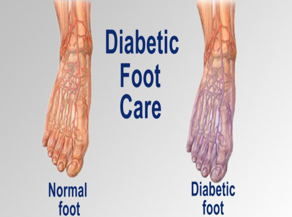 แผลเบาหวาน (Diabetic Foot Ulce) 1